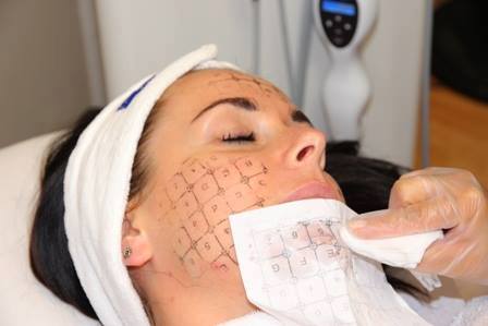 Thermage Treatment Bilbao